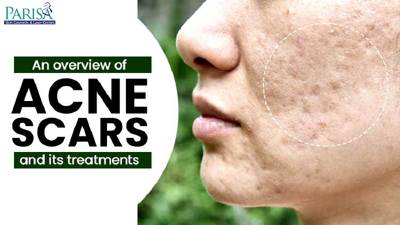 Overview Of Acne Scars Treatments