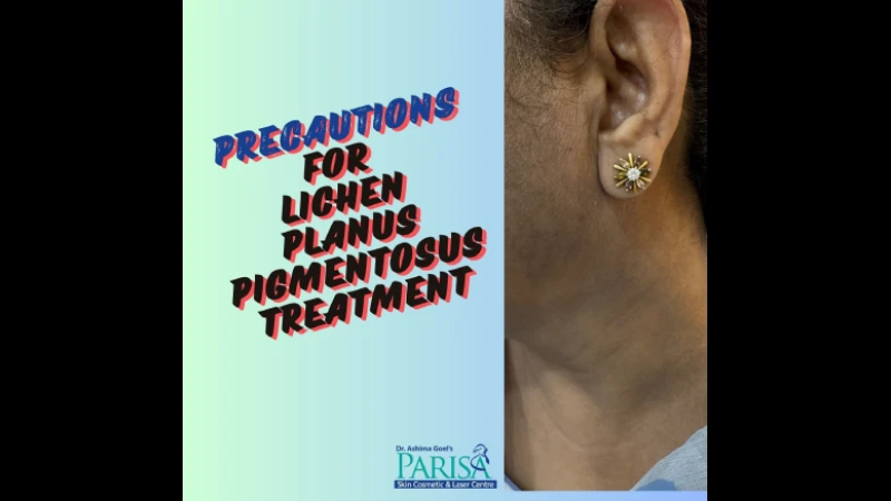 एल पी पी ( lichen planus Pigmentosus, LPP) के मरीज़ों के लिए कुछ हिदायतें रहती है जैसे कि