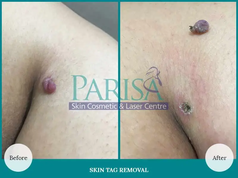 Skin Tag Removal