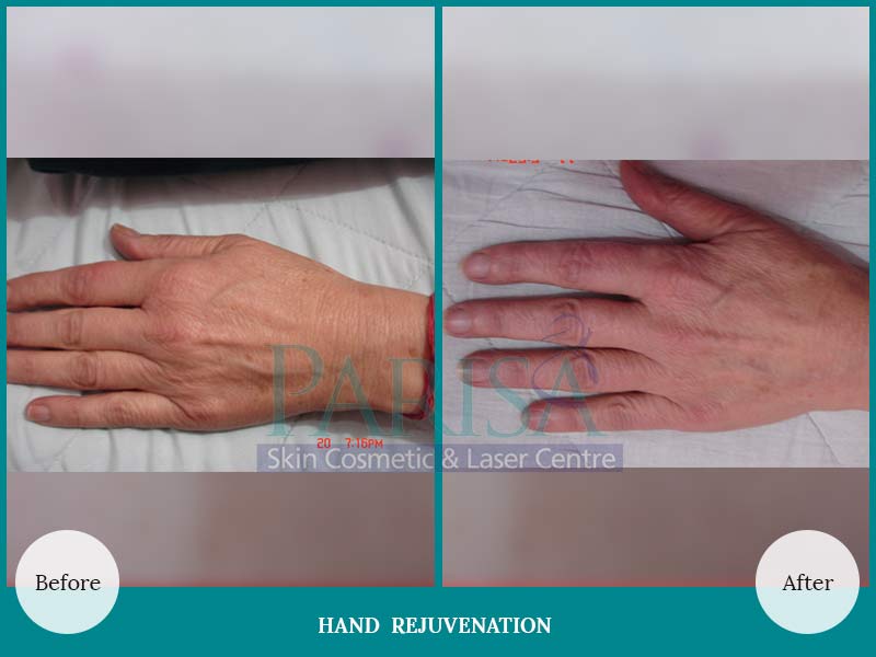 Hand Rejuvenation