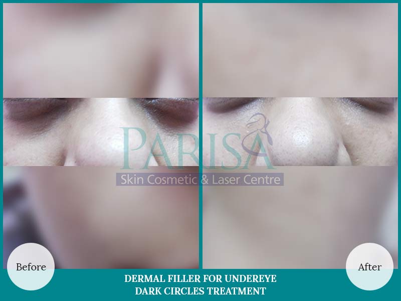 Dermal Filler