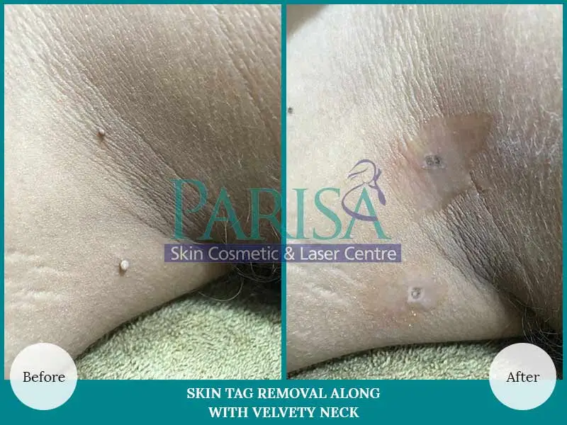 Skin Tag Removal