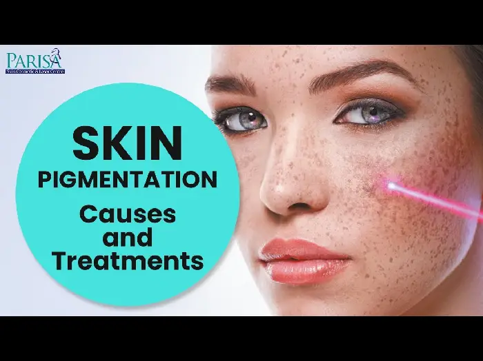 Skin Pigmentation: Causes & Treatments