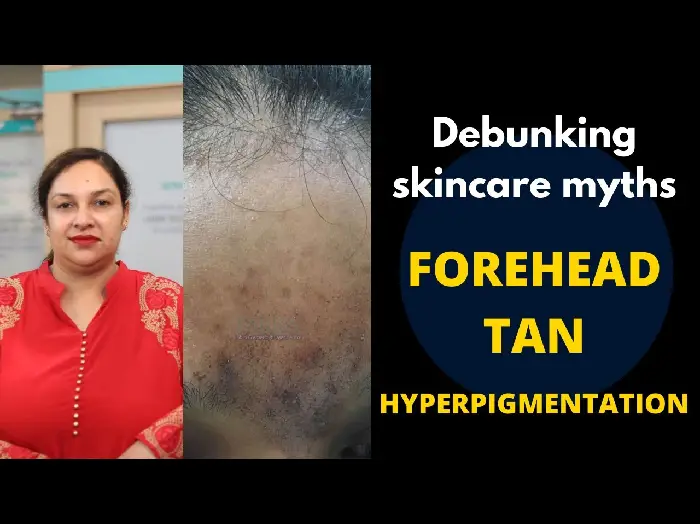 How to get rid of Hyperpigmentation/Forehead Tan | Dark Spots (Hyperpigmentation Treatment)