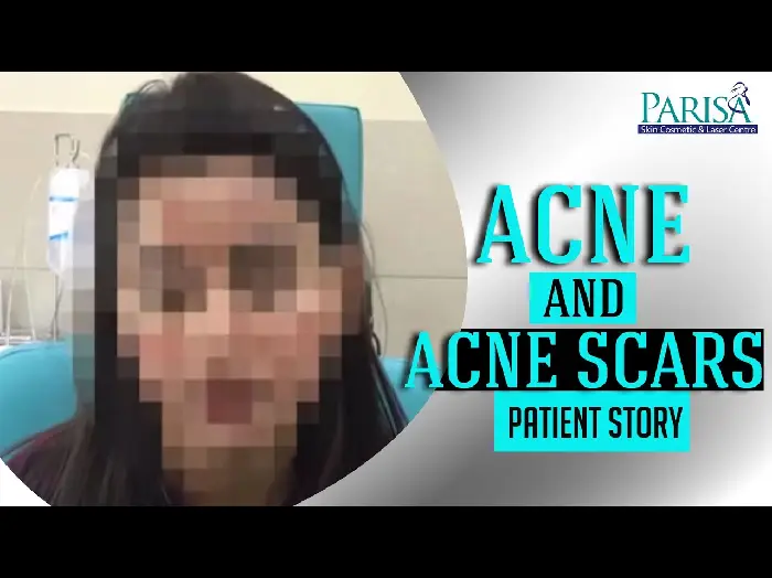 Acne & Acne Scar